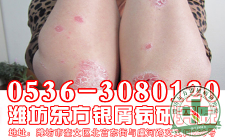 山东银屑病医院—银屑病的高发节气怎么办？