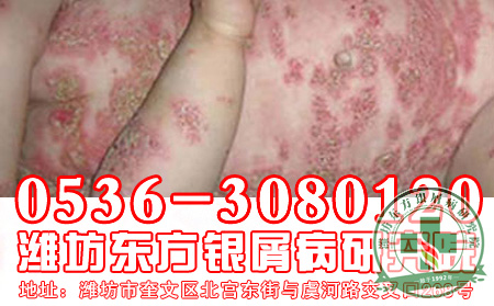 山东银屑病医院—中药治疗银屑病关注事项