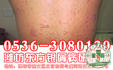 脓疱型牛皮癣有哪些危害？