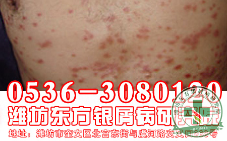 关节型牛皮癣的危害有哪些？
