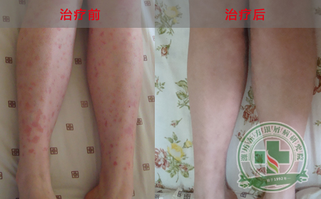 中药能不能治可以银屑病
