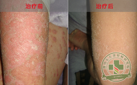 中药药浴治疗银屑病效果如何？