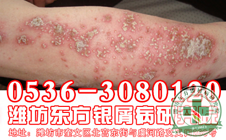 哪些因素会导致银屑病？