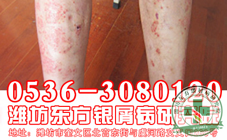 银屑病消退红斑变大和治疗方案