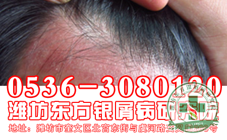 银屑病为什么会产生头屑呢？