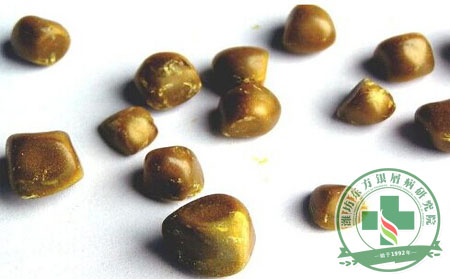 牛皮癣睡姿单一易结石