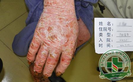 关节性银屑病