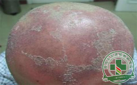 头部牛皮癣患者脱发怎么办？