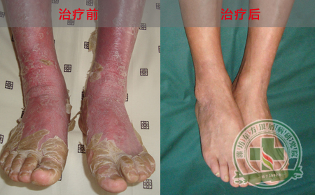银屑病用药不当的危害