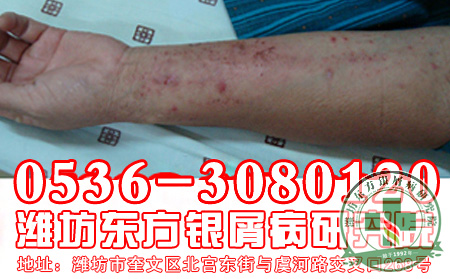 患者切忌：银屑病初期治疗非常关键