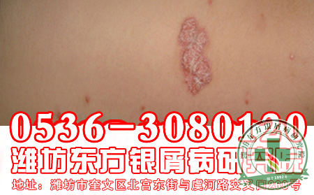 如何提高银屑病的 率？