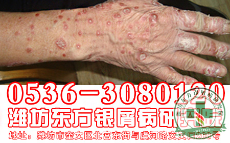 什么是关节型银屑病？