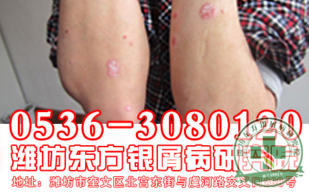 银屑病能早上洗头吗？