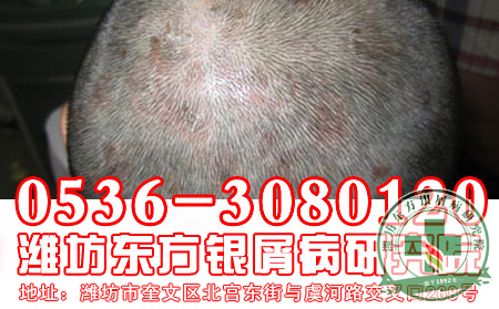 银屑病频繁洗头可以吗？