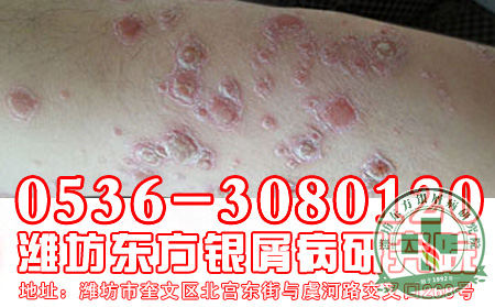 银屑病的产生与种族有关系吗？