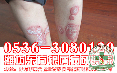 女性银屑病治疗需要更加用心