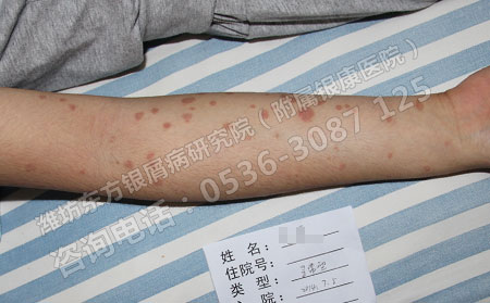 济南牛皮癣会隔代遗传吗