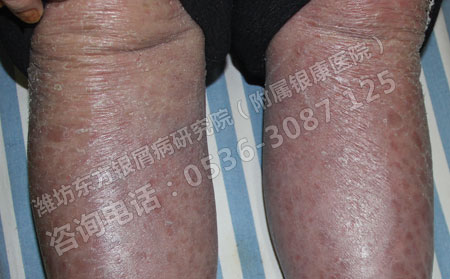 济南银屑病患者总是治不可以的原因