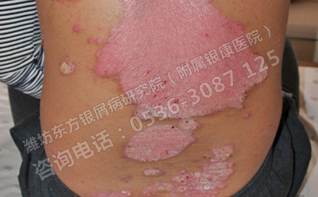 济南银屑病患者去哪里治疗可以