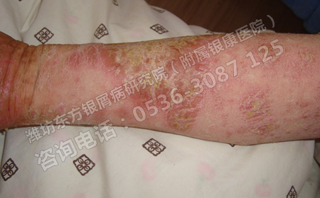 银屑病通过什么途径传染