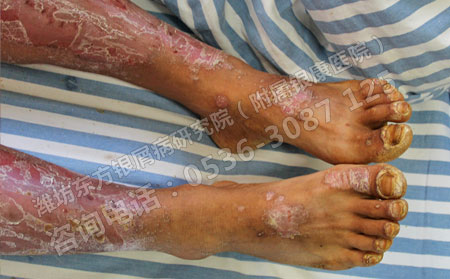 局限性脓疱型银屑病症状有哪些