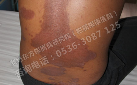 牛皮癣患者怎么做好更快获得恢复呢?