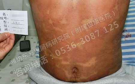 牛皮癣临床表现不严重还用治疗吗