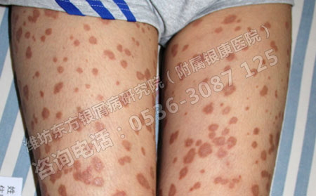 牛皮癣患者如何少走误区治可以多年复发的疾病呢