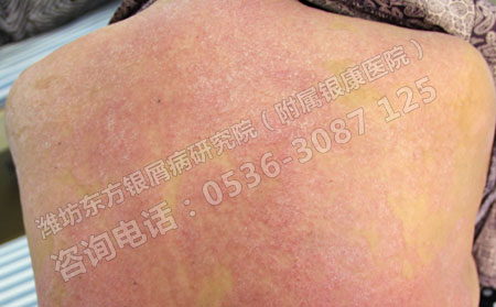 如何诊断是不是牛皮癣发病了呢