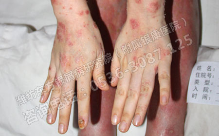 牛皮癣患者在医院就医流程是咋样的