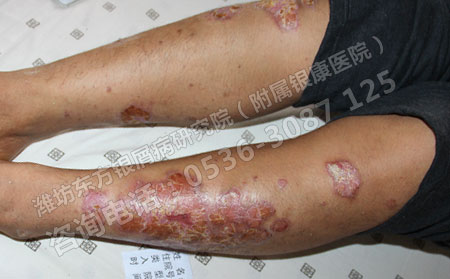 治疗银屑病的医院选择哪家可以
