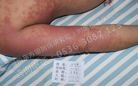 济南治疗牛皮癣医院端午有医生值班吗