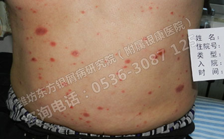 济南牛皮癣临床治疗