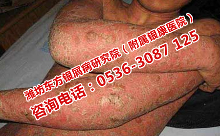 济南治疗牛皮癣的医院