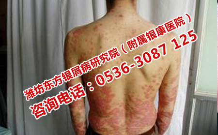治疗牛皮癣有什么可以方法