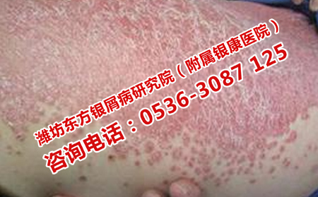 济南暑期治疗牛皮癣