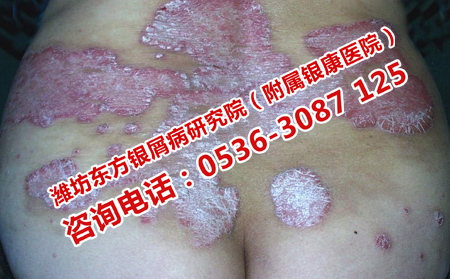 皮肤上牛皮癣红斑怎么治疗