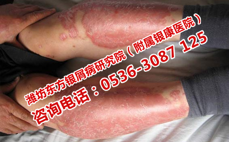 怎么降低牛皮癣复发频率