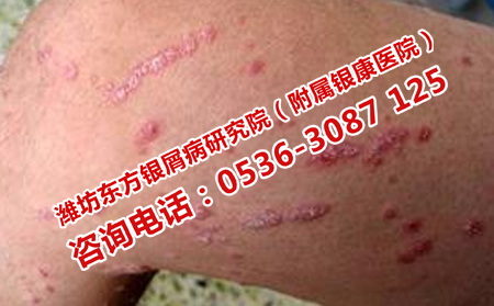 哪家医院治银屑病