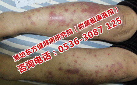 怎么治疗牛皮癣减少费用