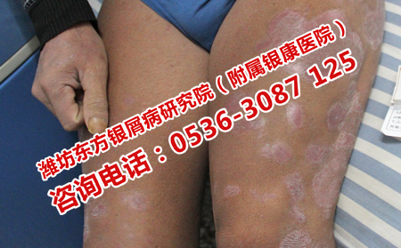 治疗牛皮癣收费低