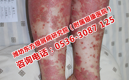如何更加有效的治疗牛皮癣
